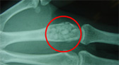 骨欠損部への顆粒品補填例の写真